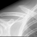 clavicle fracture 2