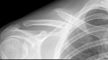 clavicle fracture 2