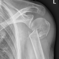 proximal humerus fracture