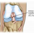 Anterior Cruciate Ligament Tear