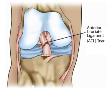 Anterior Cruciate Ligament Tear