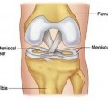 Meniscus tear