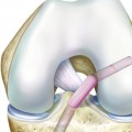 Anterior Cruciate Ligament Tear 2 3