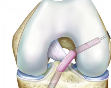Anterior Cruciate Ligament Tear 2 3