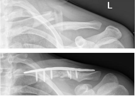 Surgery-Clavicle-Fractures