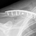 clavicle fracture 1