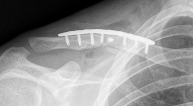 clavicle fracture 1