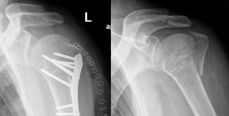humerus-fractures1
