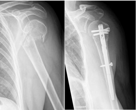 humerus-fractures2
